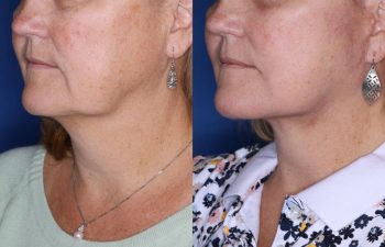 57 year old female 2 months post op from undergoing a KalosLift (Extended Deep Plane Facelift) and platysmaplasty.