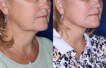 57 year old female 2 months post op from undergoing a KalosLift (Extended Deep Plane Facelift) and platysmaplasty.