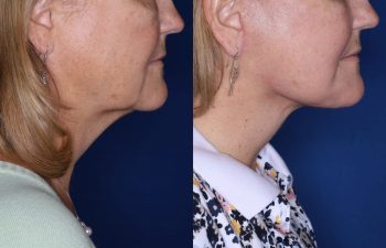 57 year old female 2 months post op from undergoing a KalosLift (Extended Deep Plane Facelift) and platysmaplasty.