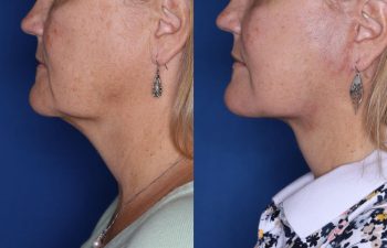 57 year old female 2 months post op from undergoing a KalosLift (Extended Deep Plane Facelift) and platysmaplasty.