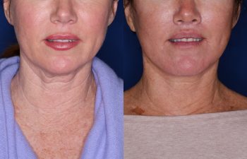 51 year old female 5 months post op from KalosLift (Extended Deep Plane Facelift) with platysmaplasty & Perialar Lip Lift.