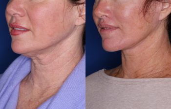 51 year old female 5 months post op from KalosLift (Extended Deep Plane Facelift) with platysmaplasty & Perialar Lip Lift.