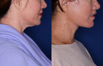 51 year old female 5 months post op from KalosLift (Extended Deep Plane Facelift) with platysmaplasty & Perialar Lip Lift.