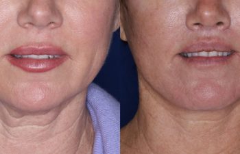 51 year old female 5 months post op from undergoing the Perialar Lip Lift.