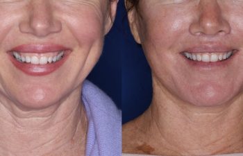 51 year old female 5 months post op from undergoing the Perialar Lip Lift.