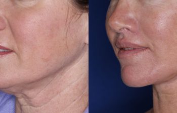 51 year old female 5 months post op from undergoing the Perialar Lip Lift.