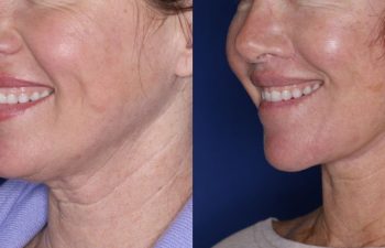 51 year old female 5 months post op from undergoing the Perialar Lip Lift.