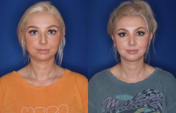 26 year old female 1 month post op from cosmetic rhinoplasty and 6 months post op from chin implant.