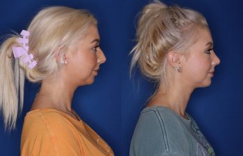 26 year old female 1 month post op from cosmetic rhinoplasty and 6 months post op from chin implant.