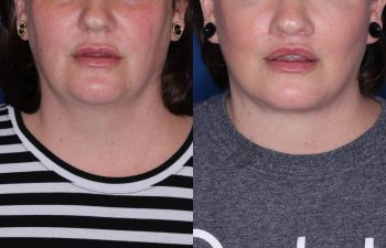 37 year old female 4 months post op from Perialar Lip Lift.