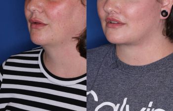 37 year old female 4 months post op from Perialar Lip Lift.