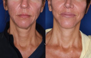 46 year old female 3 months post op from KalosLift ( Extended Deep Plane Facelift) with platysmaplasty.