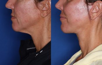 46 year old female 3 months post op from KalosLift ( Extended Deep Plane Facelift) with platysmaplasty.