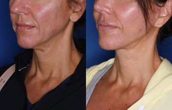 46 year old female 3 months post op from KalosLift ( Extended Deep Plane Facelift) with platysmaplasty.