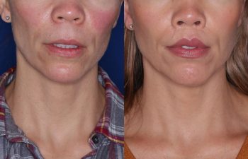 44 year old female 23 months post op from Perialar Lip Lift