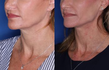 39 year old female 15 months post op from KalosLift (Extended Deep Plane Facelift) with platysmaplasty.