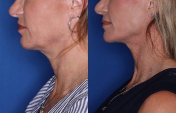 39 year old female 15 months post op from KalosLift (Extended Deep Plane Facelift) with platysmaplasty.