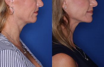 39 year old female 15 months post op from KalosLift (Extended Deep Plane Facelift) with platysmaplasty.