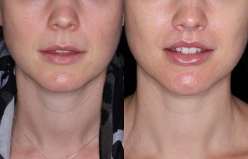 32 year old female 8 months post op from Perialar Lip Lift