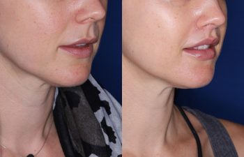 32 year old female 8 months post op from Perialar Lip Lift