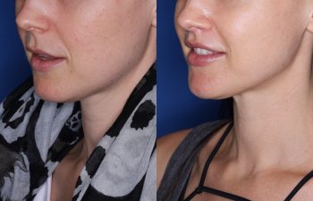 32 year old female 8 months post op from Perialar Lip Lift