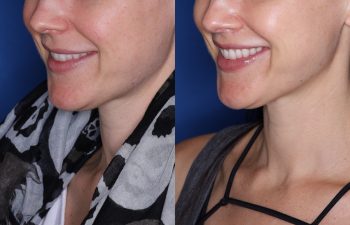 32 year old female 8 months post op from Perialar Lip Lift