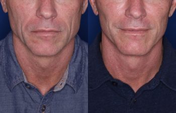 56 year old male 8 months post op from KalosLift (Extended Deep Plane Facelift.)