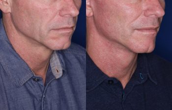 56 year old male 8 months post op from KalosLift (Extended Deep Plane Facelift.)