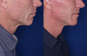 56 year old male 8 months post op from KalosLift (Extended Deep Plane Facelift.)