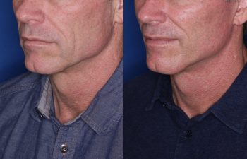 56 year old male 8 months post op from KalosLift (Extended Deep Plane Facelift.)