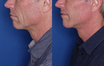 56 year old male 8 months post op from KalosLift (Extended Deep Plane Facelift.)