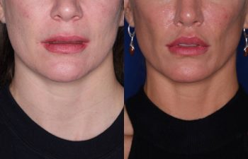 40 year old female 9 months post op from Perialar Lip Lift.