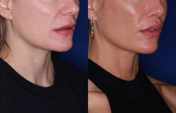 40 year old female 9 months post op from Perialar Lip Lift.