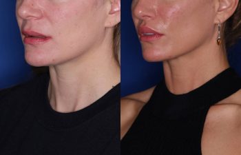 40 year old female 9 months post op from Perialar Lip Lift.