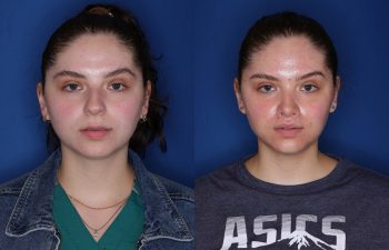 26 year old female 6 months post op from cosmetic rhinoplasty & perialar lip lift.