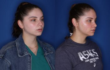 26 year old female 6 months post op from cosmetic rhinoplasty & perialar lip lift.