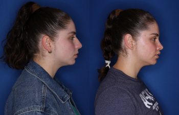 26 year old female 6 months post op from cosmetic rhinoplasty & perialar lip lift.