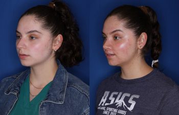 26 year old female 6 months post op from cosmetic rhinoplasty & perialar lip lift.