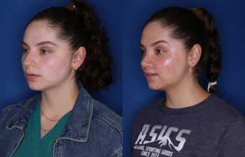 26 year old female 6 months post op from Cosmetic Rhinoplasty.