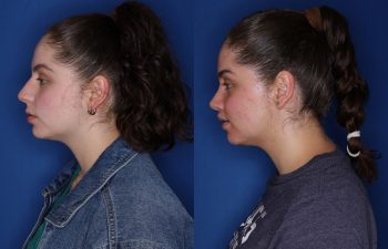 26 year old female 6 months post op from cosmetic rhinoplasty & perialar lip lift.