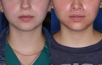 26 year old female 6 months post op from Perialar Lip lift.