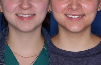 26 year old female 6 months post op from Perialar Lip lift.