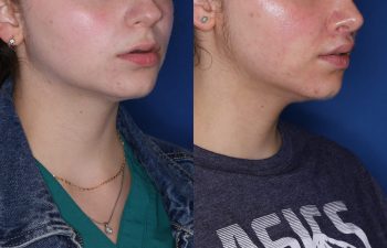 26 year old female 6 months post op from Perialar Lip lift.