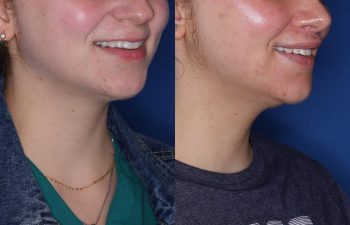 26 year old female 6 months post op from Perialar Lip lift.