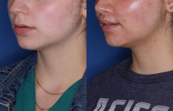 26 year old female 6 months post op from Perialar Lip lift.