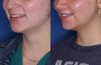 26 year old female 6 months post op from Perialar Lip lift.