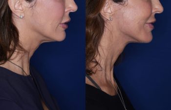 53 year old female 8 months post op from KalosLift with platysmaplasty.