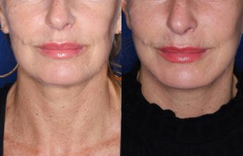 56 year old female 3 months post op from revision facelift performed using KalosLift (Extended Deep Plane Facelift) with platysmaplasty.