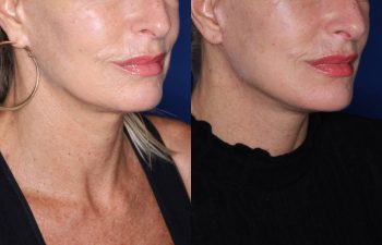 56 year old female 3 months post op from revision facelift performed using KalosLift (Extended Deep Plane Facelift) with platysmaplasty.