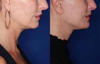 56 year old female 3 months post op from revision facelift performed using KalosLift (Extended Deep Plane Facelift) with platysmaplasty.